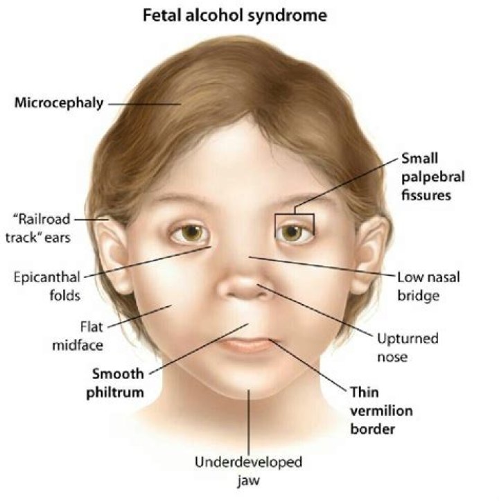Bella Ramsey And Fetal Alcohol Syndrome